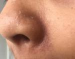 Помощь с определением диагноза кожа лица пятно зуд себорея сухая фото 1