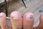 Темные пятна на ногтях больших пальцев ног фото 1