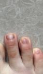Полосы на ногтях, гематома или меланома? фото 1