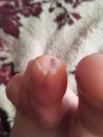 Подкожное пятно на пальце ноги фото 1