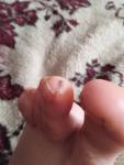Подкожное пятно на пальце ноги фото 2