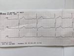 Подозрение на экстрасистолию фото 2