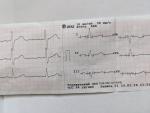 Подозрение на экстрасистолию фото 3