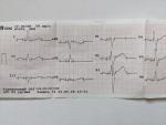 Подозрение на экстрасистолию фото 5