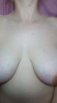 Красные высыпания на груди при беременности фото 2
