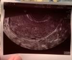 Беременность 3 недели фото 3