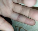 Перелом пальца руки фото 3