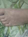 Странные пятна похожие на синяки на ногах и руке фото 3