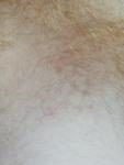 Сыпь на коже на грудной клетке с правой стороны фото 2