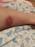 Не зудящее пятно на ноге Багрового цвета после санатория фото 1