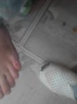 Опух палец у ребенка на ноге, сильная боль и кривой фото 2
