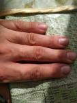 Утолщение, шелушение и разтрескивание кожи пальцев рук фото 4
