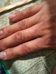 Утолщение, шелушение и разтрескивание кожи пальцев рук фото 5