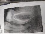 Болит зуб после пломбирования каналов фото 1