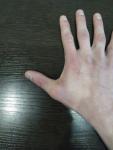 Нарост шишка на большом пальце после травмы удара фото 1