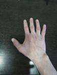 Нарост шишка на большом пальце после травмы удара фото 2
