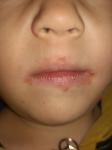 Дерматит вокруг рта у ребенка фото 1