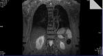 Пятно в легких на МРТ снимках фото 5