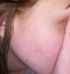 Бугорки на лице после родов с фото фото 2