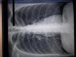 Рентген грудной клетки при пневмонии фото 1