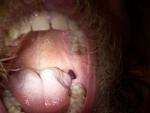 Кровавое вздутие за крайним коренным зубом фото 1