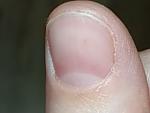 Коричневое пятнышко на ногте. Боль при надавливании фото 1