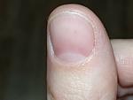 Коричневое пятнышко на ногте. Боль при надавливании фото 2