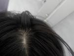 Залысина на голове, выпадения волос фото 1