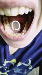 Лейкоплакия полости рта, тревожность фото 3