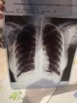 Описание рентгена. Бронхит, трахеит, астма? фото 1