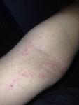 Раздражение на коже, атопический дерматит фото 1