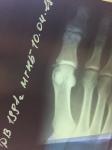 Перелом большого пальца ноги фото 1