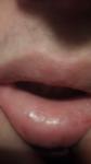 Появились пузырьки на слизистой нижней губы фото 2