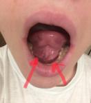 Воспаление под языком, образование рядом с горлом фото 2