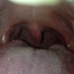 Хорошо ли заживает горло после операции по удалению миндалин? фото 1