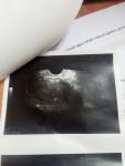 Трубная беременность фото 3