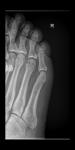 Есть ли перелом на снимке рентгена пальцев ноги фото 3