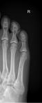 Есть ли перелом на снимке рентгена пальцев ноги фото 1