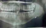 Инородное тело после удаления зуба мудрости фото 1