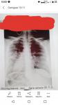 Пневмония или туберкулез фото 1