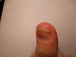 Водяные пузырьки около ногтя и под ногтем пальцев рук фото 2