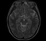 Опухоль мозга фото 3