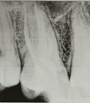 Болит депульпированный зуб фото 1