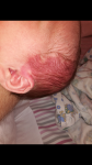 Красное большое пятно на пол головы у ребёнка новорожденного фото 1