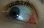 Воспаление внутреннего уголка глаза? фото 3