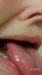 Кровяные пузыри на щеке и языке фото 1