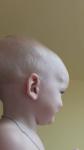 Костные шишки у ребенка на веске и за ухом фото 1