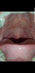 Болит язык и пузырьки в горле фото 1