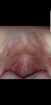 Болит язык и пузырьки в горле фото 2