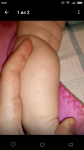 Сыпь без диагноза у ребёнка на ступенях и ладонях фото 2